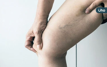 水腫怎麼辦？多喝水有效嗎？5招「快速消水腫」多吃香蕉、奇異果