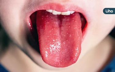 初期症狀與流感相似！醫揪「猩紅熱」關鍵特徵：舌頭發紅凹凸不平