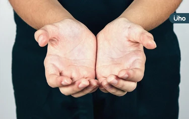 為什麼會流手汗？哪些人容易流手汗？夏天掌心濕黏「4妙招」能改善