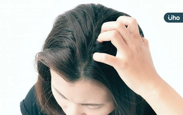 天熱頭癢、頭皮屑多⋯當心頭皮健康警訊！醫列「6大徵兆」恐致掉髮