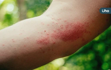 皮膚紅疹小心禽蟎上身！醫揭「這些部位」易被叮咬：嚴重恐長水疱