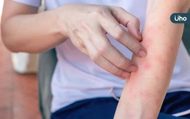 蕁麻疹反覆發作？「慢性蕁麻疹」像全身爬滿螞蟻：持續●●週快就醫