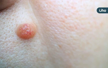 腹股溝冒小腫塊⋯「贅生皮」是什麼？醫警告：嚴重恐造成「皮膚壞死」