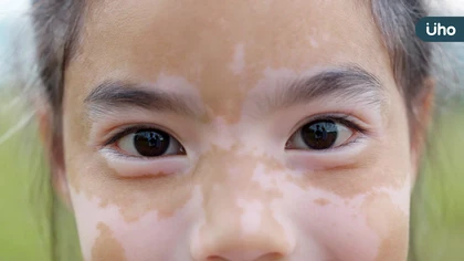 8歲女童患白斑症  醫病共同控制病情