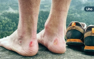 穿新鞋起水泡怎麼辦？教你正確處理「摩擦性水皰」千萬別自己弄破