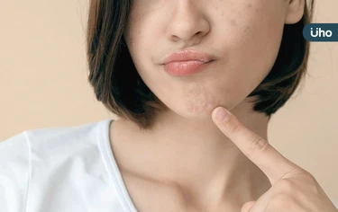 別再不戴口罩，小心空污害臉發炎！醫揭「恐怖真相」教3招自救抗痘