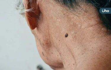 臉上長微凸的痣，竟然是皮膚癌？醫揪「基底細胞癌」好發於曝曬部位