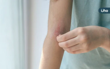 有食譜》汗皰疹用吃的就能改善？中醫教你做「綠豆藕片湯」涼血止癢