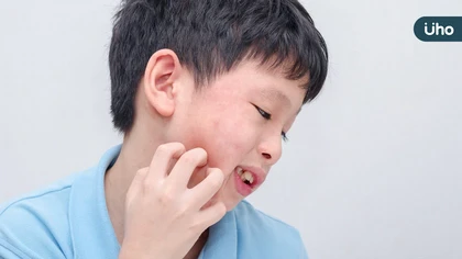 健保放寬口服小分子標靶藥給付至兩年 異位性皮膚炎迎來治療新曙光