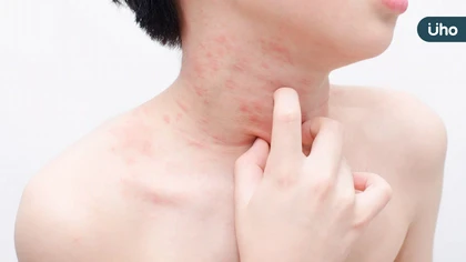 十月一日是世界蕁麻疹日！