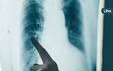 肺腺癌致癌機轉找到了!研究揭「防腐劑、汽機車廢氣」都是元兇之一