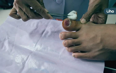 他小腿割傷「潰爛紅腫」險截肢！醫揭傷口清潔「先做這事」防感染