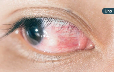 紅眼久未痊癒、有異物感⋯小心成「腺病毒性結膜炎」拖久害視力受損