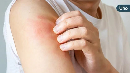 異膚治療不中斷！健保新藥想要「再上車」，病友該怎麼做？