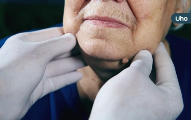 婦人額頭「長硬塊」沒理會，檢查才知是骨瘤！醫示警「4症狀」快就醫