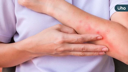 異位性皮膚炎治療新趨勢：從生物製劑到生活調適，找回穩定與自信