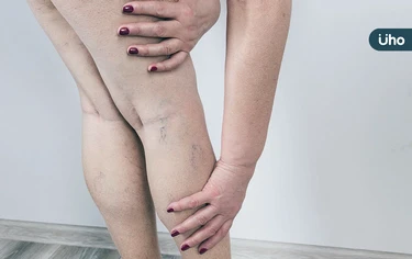 久站「靜脈曲張」發癢抽筋怎消除？醫用1招「膠水黏靜脈」擺脫蜈蚣腿
