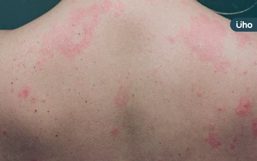 蕁麻疹皮膚癢又腫，不吃藥會自己好？醫揭「這類型」與免疫失調有關