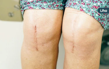 淋巴水腫竟成「大象腿」？醫揭「病程可達數10年」嚴重恐面臨截肢