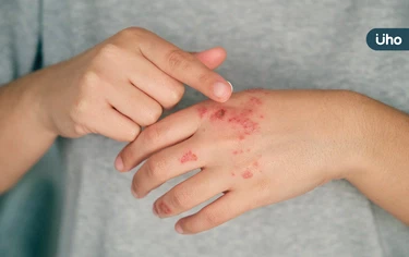 有食譜》汗皰疹與手腳濕氣重有關！中醫推「三妙祛濕茶」有效止癢