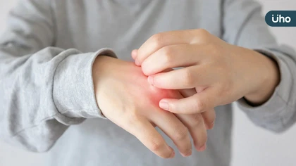 20歲男大生乾癬疾病延燒關節誤認痛風，醫籲提早控制發炎為關鍵