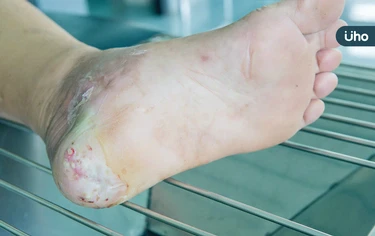 糖尿病一定會截肢嗎？就怕傷口難癒合！醫用「幹細胞」逆轉截肢危機