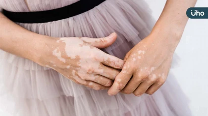 白斑少年被偷走「顏色」的青春 醫:新一代標靶藥物助找回「色彩」