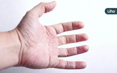 搔癢、脫皮⋯富貴手會自己好嗎？盤點「誘發原因」洗衣精、肥皂全上榜