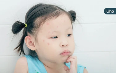 童全身紅疹以為蟲咬，竟是水痘上身！醫警告「成人更嚴重」恐致腦炎