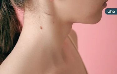 為什麼身體會長肉芽？可以自己剪掉嗎？揭秘「皮膚贅疣」7QA一次看