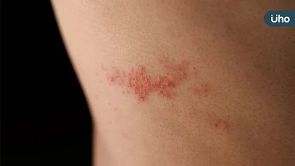 帶狀疱疹後神經痛難纏 中醫4大食療方對症調理