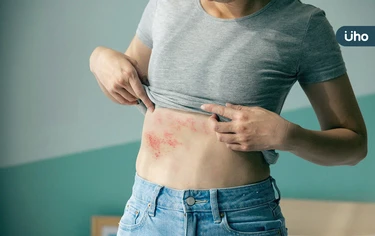 婦罹「皮蛇」輕觸就痛⋯醫揭癒後當心「1後遺症」恐致長期神經疼痛