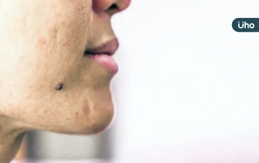 臉上突長黑斑，恐是皮膚癌徵兆！醫揪「基底細胞癌 」好發曝曬部位