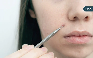 女亂擠痘痘竟害肺部破洞！醫示警「臉部危險三角區」千萬別亂碰