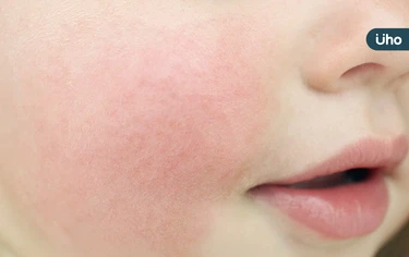 臉紅、流鼻水⋯蘋果病「微小病毒B19」是什麼？醫示警「4症狀」要小心