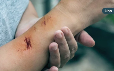 撕裂傷、燒傷、割傷⋯受傷要打破傷風疫苗嗎？快學「緊急處理4步驟」