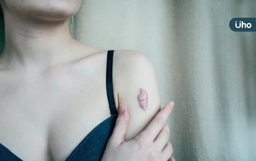 蟹足腫是什麼？醫示警「3情況」恐害皮膚反覆發炎感染：首先別熬夜