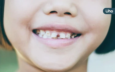 以為孩子門牙歪、蛀牙⋯檢查竟是「多生牙」一定要拔嗎？醫評估5關鍵