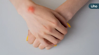 手腕腫塊別輕忽!腱鞘囊腫成因、好發族群與中醫調理重點一次看