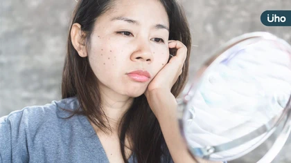 中醫體質調理多囊性卵巢:辨證分型搭配飲食與生活改善月經與痘痘問題