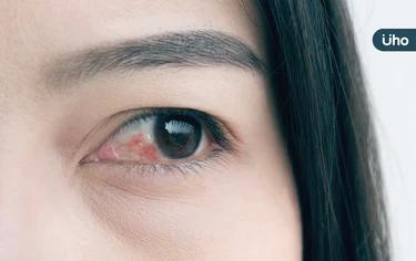 眼睛紅癢不適⋯我是乾眼症還是結膜炎？醫教你分辨兩者差別「1關鍵」