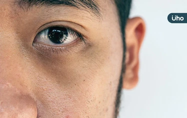 黑眼圈是身體出問題？會自己消？黑眼圈原因、類型、改善方法一次看