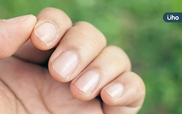 指甲會長腫瘤?皮膚科醫示警「這些變化」別忽視:常被誤認甲溝炎