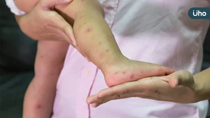 OPEN現身萬芳醫院陪童過節 洗手操防腸病毒寓教於樂