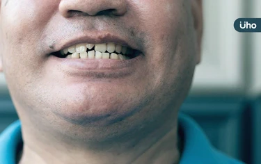 65歲以上平均缺牙13顆！牙醫教「假牙清潔2招」防感染、真牙流失