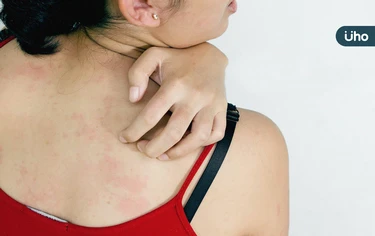 今年首例萊姆病境外移入！北部6旬女紅癢、血尿⋯醫：病程恐拖數年