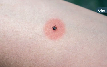 萊姆病是什麼？萊姆病原因、症狀、治療解析：恐引發心臟、神經病變