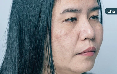 不是法令紋！臉上有這條皺紋「疲憊又蒼老」日美容醫授5招預防惡化