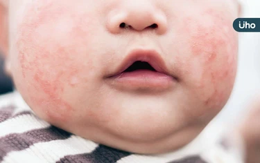 「過敏性休克」短時間當心致命！醫揭臉腫、嘴唇腫⋯這些症狀快送急診