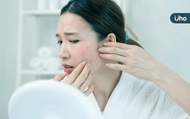 為什麼臉上長滿痘痘？青春痘成因、保養方法一次看：避免過度清潔